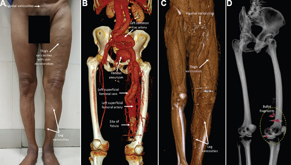 (A) Clinical photograph showing skin discolouration and superficial varicosities along the left inguinal region, thigh and leg. (B and C) Computed tomography angiography showing fistulous communication between the left superficial femoral artery and vein in the lower third of the thigh with aneurysmally dilated and extremely tortuous iliac and femoral arteries and veins as well as superficial varicosities. (D) Retained bullet fragments noted adjacent to the fistula.